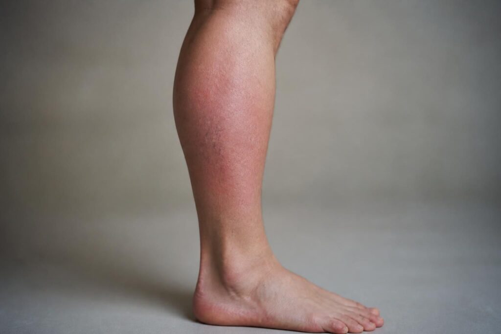 découvrez comment identifier les symptômes de la phlébite au niveau du mollet et de la jambe pour agir rapidement et prévenir les complications.